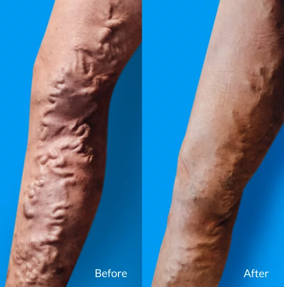 before and after Legs surgery